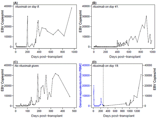 Figure:. Late and sustained EBV reactivation in 4 cord/haplo transplant recipients