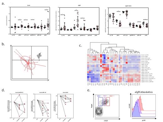 Figure 1. (a) Basal, aIgM induced and aIgM+H2O2 induced phosphorylation of key nodal signaling proteins in WM (red) and Healthy Donor B-cells (black), (b) Principal component analysis of the generated phosphosignatures distinguishes WM from Healthy Donor B-cells, (c) Hierarchial clustering analysis distinguishes patient subsets with distinct BCR-phosphosignatures, (d) Ibrutinib trial: Representative change in basal levels of phosphorylation for 3 phosphoproteins on 6 months and 12 months of treatment (normalized to the pretreatment baseline), (e) WM subset analysis based on CD20 expression shows interclonal differential signaling (here LYN activation is shown in a representative WM sample).