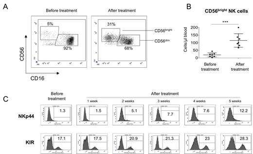 Fig 1. Effect of HDC plus IL2 on NK cells of AML patients. A) Representative dot plots of the CD56bright and CD56dim NK cell subpopulations from an AML patient treated with histamine+IL2 before and after treatment. B) Absolute cell numbers of CD56bright NK cells of 7 AML patients before and after treatment, *** p<0.01. C) Follow-up of NKp44 and KIR expression after HDC plus IL-2 therapy. Shown are histograms for NKp44 and KIR expression on total CD56+ CD3- NK cells of one patient representative for the majority of patients tested.