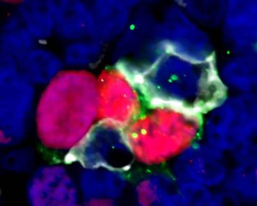 Figure 1. High power view (x60 zoom) of follicular lymphoma showing proliferating cells in close contact with TFH cells. Ki67 (red), PD1 (white), ICOS (green), DAPI (blue)