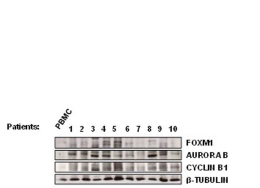 Figure 1A:. FOXM1 overexpression in both B-ALL patients (A) and cell lines (B).