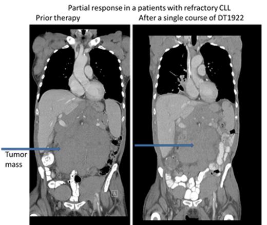 Figure 1. CT images of 77 year old patient with refractory CLL after a single course of DT1922 at dose level 40 µg/kg.
