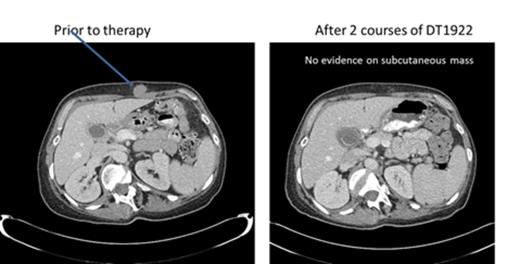Figure 2. 53 year old female with CD22+CD19+ relapse marginal zone lymphoma received 2 courses of DT1922 ( 60 µg/kg and 40 µg/kg) and attained a complete resolution of subcutaneous tumor mass.