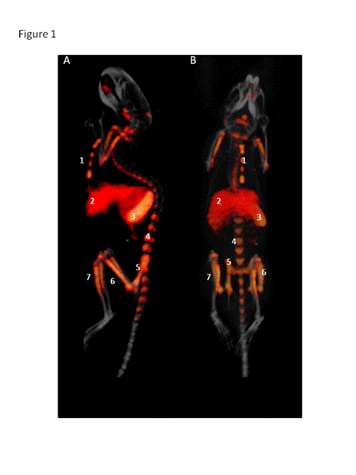 Figure 1:. SPECT/CT image of Asparaginase uptake