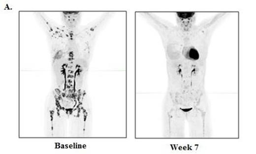 Figure 1. Baseline and week 7 re-staging studies in a classical Hodgkin lymphoma patient after 2 doses of ipilimumab at 10 mg/kg. A. PET/CT scan and B. Bone marrow (CD30 stain)