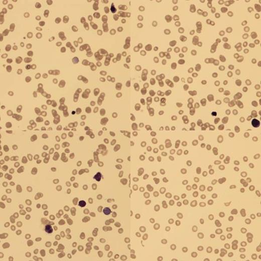 Fig 1:. BF showed poikilocytes, teardrops, macrocytes and NRBC with binucleate forms.