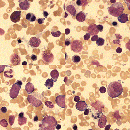 Fig 2:. The bone marrow aspirate was hypercellular with erythroid hyperplasia, dyserythropoiesis and no ring sideroblasts.