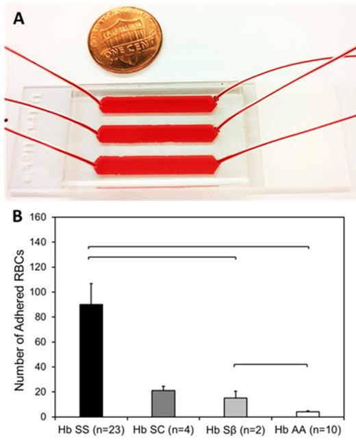 Figure 1. A functional assay for RBC adhesion in SCD (A) The SCD-Biochip allows serial examination of RBC adhesion and deformability to endothelium-associated proteins and provides closed, preprocessing-free, and direct analysis of blood. (B) Identification of different phenotypes in SCD-Biochip based on adhesion of RBCs (per unit area of 32 mm2) to fibronectin immobilized microchannels.