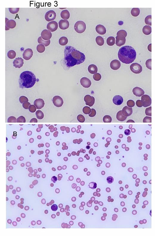 Figure 3:. Peripheral smear findings