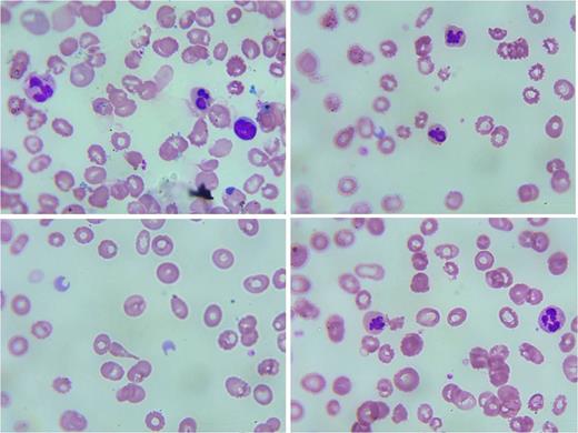 Fig 1:. Blood Film
