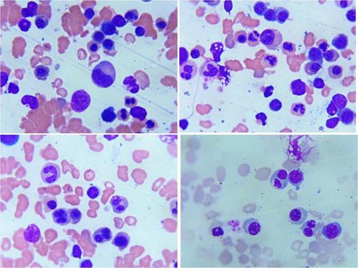 Fig 2:. Bone Marrow