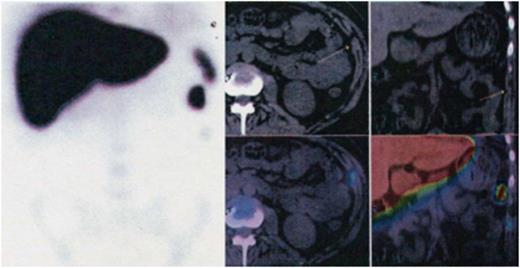 Figure 1:. Absence of spleen due to splenectomy. There are three abnormal zones marked by radiotracer in the left upper quadrant.