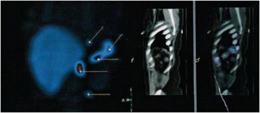 Figure 2:. Evidence of five accessory spleens.