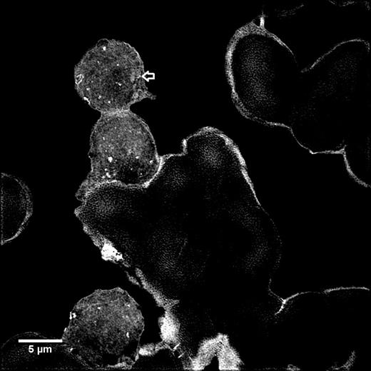Figure 1:. Granular B-ALL bone marrow aspirate sample imaged with SIM and converted to a maximum intensity Z projection, arrow indicates a granule