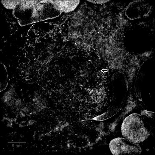 Figure 2:. AML bone marrow aspirate sample imaged with SIM and converted to a maximum intensity Z projection, arrow indicates a granule