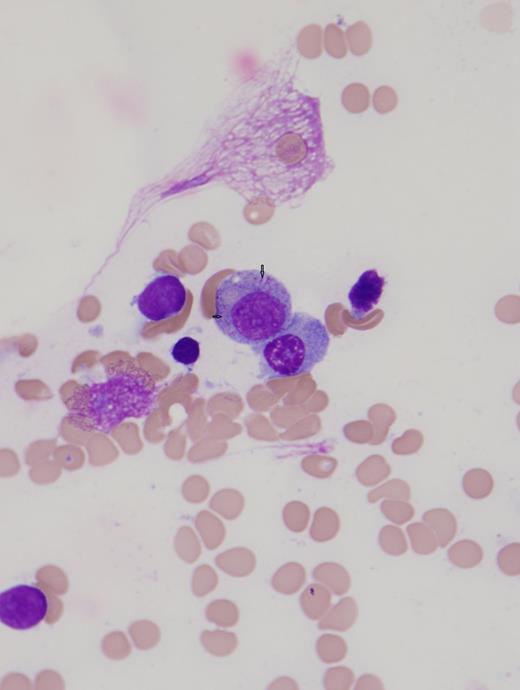 Figure 3:. AML bone marrow aspirate sample imaged with a brightfield light microscope and magnified 100 times, arrows indicate granules