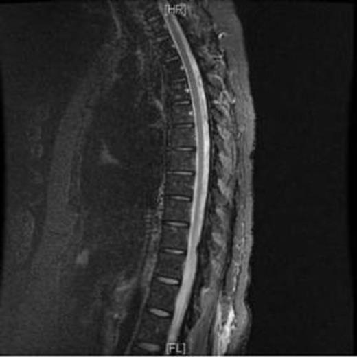 Figure 1. Leptomeningeal reinforcement as seen in MRI.
