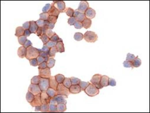 Figure 2a:. CD 20+ and 2b: kappa + neoplastic cells in CSF