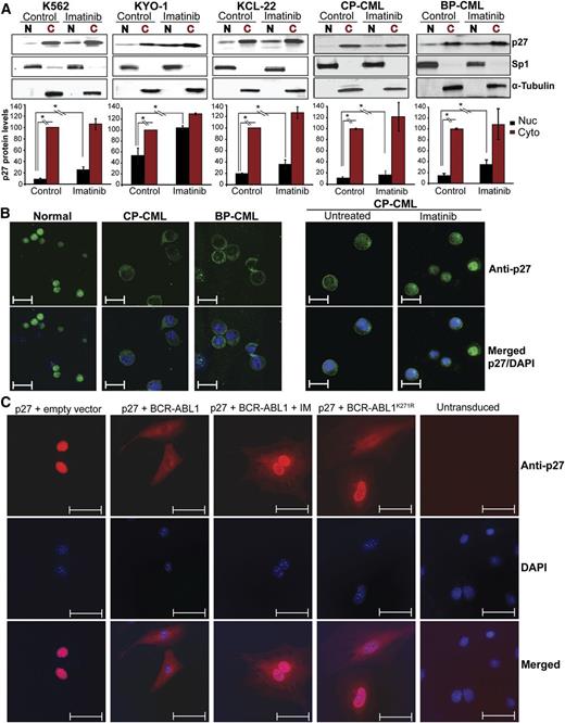 Figure 1. Effect of BCR-ABL1 kinase inhibition and kinase-inactive BCR-ABL1 on subcellular localization of p27 in CML cells. (A) CML cell lines (K562, KYO-1, and KCL-22) and CD34+ cells from CML patients (N = 11) in CP (N = 8) or BP (N = 3) were treated with imatinib for 16 hours. Cell lines were serum starved in 1% serum and primary samples were cultured in cytokine-free 20% BIT media before performing the experiments. Cytoplasmic (C) and nuclear (N) proteins were fractionated and subjected to immunoblot analysis, using Sp1 and α-tubulin distribution to monitor the purity of the nuclear and cytoplasmic fractions, respectively. Representative immunoblots are shown. Densitometry was performed by normalizing nuclear and cytoplasmic p27 protein levels to levels of Sp1 and α-tubulin, respectively. Expression of untreated cytoplasmic p27 levels was set to 100%. Values represent mean ± SD from 3 independent experiments. *P < .050. (B) Subcellular localization of p27 was analyzed by immunofluorescence (IF) microscopy in CD34+ cells from BM of normal donors or CML patients. Left panel, cells were freshly isolated; right panel, cells were treated with imatinib in cytokine-free 20% BIT media. Representative experiments are shown. Scale bars represent 10 μm. (C) p27−/− MEFs were stably cotransduced with RFP-p27 (wild type) and GFP retroviral vectors containing native BCR-ABL1, the kinase-inactive BCR-ABL1K271R mutant, or empty vector controls. Cells engineered to express native BCR-ABL1 were also treated with 2.5 μM imatinib for 16 hours. Double-positive (GFP+/RFP+) cells were sorted by FACS and the subcellular localization of p27 was visualized by IF using an Alexa Fluor-647–conjugated secondary antibody. Coexpression of GFP and RFP was verified under the microscope. DAPI was used for nuclear staining. Scale bars represent 20 μm. Quantification of nuclear/cytoplasmic p27 signal intensity is shown in supplemental Figure 3. BIT, bovine serum albumin, insulin, and transferrin; DAPI, 4,6 diamidino-2-phenylindole; GFP, green fluorescent protein; RFP, red fluorescent protein.