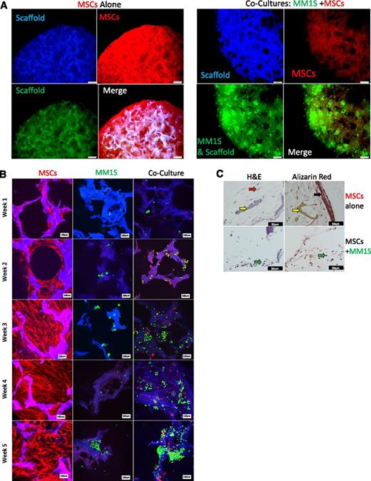 Figure 2. Inhibited osteogenesis induced by myeloma in a 3D bone model. (A) Fluorescent imaging at week 5 (TurboRFP+MSCs, red; GFP+MM1S, green; scaffold, blue). Overlaid channels (merge) shows increased pore infiltration, elongation, and proliferation by MSCs when grown in the absence of myeloma cells (left) compared with when grown with MM1S (right). The scale bar represents 200 μm. (B) Confocal images of TurboRFP+MSCs (red) and GFP+MM1S (green), alone or in coculture, on silk scaffolds (blue) from 1 to 5 weeks of culture in osteogenic media. The scale bar represents 100 μm. (C) Histologic analysis of scaffolds after 5 weeks of osteogenesis for MSCs alone (top) or in coculture with GFP+MM1S (bottom) stained for mineralization (Alizarin Red, right) or hematoxylin and eosin (H&E) (left). Black arrow indicates mineralization found only in MSCs cultured alone. Yellow arrows indicate silk scaffold. Red arrow indicates stromal cells, which are found throughout the MSC alone samples and sparsely through coculture samples. Green arrows indicate MM1S plasma cells found only in coculture samples. The scale bar represents 50 μm.