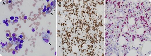 A 46-year-old man with HIV was admitted with subacute onset of fever, cough, generalized weakness, and weight loss. He went on to develop multiorgan failure with encephalopathy, acute kidney injury, fulminant liver failure, and disseminated intravascular coagulation. He was also found to have splenomegaly, pancytopenia, and cavitary lesions in the lungs at presentation. Further workup showed hyperferritinemia (>90 000 μg/L), hypertriglyceridemia (782 mg/dL), and Epstein-Barr virus (EBV) viremia (61 200 copies/mL). The diagnostic criteria for hemophagocytic lymphohistiocytosis (HLH) were met. Bone marrow biopsy showed extensive hemophagocytosis (panel A, black arrows). The infiltrating neoplastic cells were intensely positive for CD8 immunostaining, suggesting cytotoxic phenotype (panel B), and EBV RNA by in situ hybridization (panel C). Cytogenetic analysis showed complex karyotype and the T-cell gene receptor was clonally rearranged. The final diagnosis was HIV-associated EBV-positive peripheral T-cell lymphoma of cytotoxic phenotype with extensive hemophagocytosis. / The patient received supportive care, including hemodialysis, and was treated with cyclophosphamide, doxorubicin, vincristine, etoposide, and prednisone. He tolerated the therapy very well. His mental status and liver functions normalized within the following week, and renal function normalized within the next month. Given his excellent response, he is now being considered for high-dose chemotherapy and autologous stem cell transplantation.