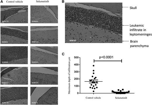 Figure 5. Selumetinib eradicates CNS leukemia in an orthotopic primagraft model. Photomicrographs of brain sections stained with hematoxylin and eosin from mice engrafted with Ras pathway mutant ALL cells (L779) after treatment with selumetinib or CV (×20 objective) (A). Photomicrograph of 1 section from CV-treated mouse after increased magnification (×40) (B). Dot plot of the depth of leukemic infiltrate into the leptomeninges in CV- vs selumetinib-treated mice (C).