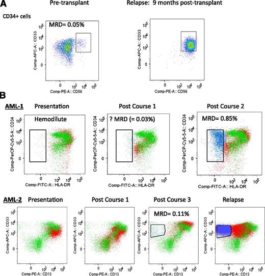 Figure 2. Examples of detecting MRD with “different-from-normal approach” applied to myeloblast population. (A) AML patient undergoing allogeneic stem cell transplant with no prior flow cytometric data available to identify diagnostic LAIP; however, pretransplant bone marrow CD34+ myeloblasts (defined by gating using CD34+/CD117+/CD45/SSC/FSC parameters) include a clearly aberrant CD34+CD33+CD56+ leukemic population and therefore are MRD-positive (0.05% of BM-nucleated cells). This patient relapsed with the same aberrant phenotype. (B) Examples of 2 AML patients (AML-1, AML-2) monitored for MRD during chemotherapy using data overlay with a control sample to detect “different-from-normal” blast subpopulations in CD117+ myeloblasts (defined by gating using CD117+/CD45/ SSC/FSC parameters). Green, CD117+ myeloblasts of control bone marrow; red, CD117+ myeloblasts of patient’s bone marrow; blue, emerging aberrant leukemic subpopulation within empty space; empty space, region in which there are very few or no normal cells. (AML-1) CD34 vs HLADR plots shown of CD117+ blasts. Presentation sample was hemodilute with no definite LAIP (other markers not shown). Postcourse 1 sample had a small number of cells in an empty space (CD34+HLADRlow, in blue) but categorized as insufficient to define as MRD without a diagnostic LAIP; however, the postcourse 2 sample had obvious MRD within the same empty space. (AML-2) CD33 vs CD13 plot shown of CD117+ blasts. Change in leukemic immunophenotype with MRD postcourse 3 from an emerging new aberrant subpopulation in an empty space (CD33+CD13low, in blue). This patient relapsed with the same aberrant phenotype but the diagnostic LAIPs were not present (including from other markers not shown).
