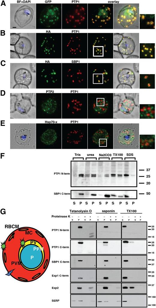 Figure 2. PfPTP1 is localized on Maurer's clefts in P falciparum–infected RBCs. (A) Immunofluorescence assay on CS2/PfPTP1-GFP cell line: the GFP signal (green) colocalizes with that of the endogenous protein (PfPTP1; red); inset: enlargement of colocalization pattern. (B) Immunofluorescence assay on CS2/PfPTP1-HA cell line: the HA signal (green) colocalizes with the α-PfPTP1 signal (red); inset: enlargement of colocalization pattern. (C) Immunofluorescence assay on CS2/PfPTP1-HA cell line: the HA-signal (green) colocalizes partially with the MC resident protein SBP1 (red); inset: enlargement of colocalization pattern. (D) Immunofluorescence assay on CS2 parental cell line: the PfPTP2-signal (green) does not overlap with the PfPTP1-signal (red); inset: enlargement of area where MC (PfPTP1) and electron dense vesicles (PfPTP2) are in close proximity. (E) Immunofluorescence assay on CS2 parental cell line: the PfHsp70-x-signal (green) colocalizes partially with the PfPTP1-signal (red); inset: enlargement of partial colocalization on J-dots (PfHsp70-x). Scale bar: 1μm; same size of ROI in each image. (F) Western blot of solubility study on CS2/PfPTP1-HA cell line: top panel: parasite-infected RBC samples were treated with different detergents and supernatants (S) and pellets (P) detected on a western blot with α-HA antibodies; bottom panel; blot from top panel was stripped and probed with an antibody against the MC resident transmembrane protein SBP1. The 15 kDa is non-specific since it is found in the other blots treated with α-PfPTP1 antibodies. (G) Schematic and western blot of protease protection assay on CS2/PfPTP1-HA-infected RBCs; parasite-infected RBC samples were lysed and either treated with Tetanolysin O, saponin or Triton X-100 (1%). Each of the samples was then treated with either PBS or Proteinase K. The western blot was then either probed with an antibody recognizing the N-terminal (top panel) or C-terminal part (bottom panel) of PfPTP1. SBP 1 is a MC marker with its C-terminus exposed to the RBC cytosol, EXP 1 and EXP 2 are integral membrane proteins of the PVM and SERP is a soluble marker of the PV.