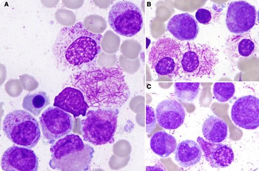 A 67-year-old man presented with easy bruising, fatigue, pancytopenia (white blood cell count, 1.9 × 109/L; hemoglobin, 10.8 g/dL; platelets, 89 × 109/L), and low-grade disseminated intravascular coagulation (international normalized ratio, 1.3; partial thromboplastin time, 22 s; fibrinogen, 93 mg/dL; D-dimer, positive). Peripheral smear showed 36% circulating promyelocytes and mild thrombocytopenia. Morphologic, immunophenotypic (positive myeloperoxidase, negative CD34, and HLA-DR by flow), and clinical findings suggested a diagnosis of acute promyelocytic leukemia (APL), and the patient was started on all-trans retinoic acid (ATRA). The bone marrow was 100% cellular with sheets of neoplastic promyelocytes containing numerous primary azurophilic granules, and few Auer rods (panels A-C). Also noted were histiocytes packed with phagocytosed Auer rods (panels A-C), as well as extracellular Auer rods (panel C). Surprisingly, fluorescence in situ hybridization (FISH) was negative for the t(15;17) involving promyelocytic leukemia–retinoic acid receptor α (PML-RARA), and the RARA break apart (17q). A normal male karyotype was reported. Nevertheless, suspicion for APL remained high and reverse transcriptase polymerase chain reaction was performed, demonstrating PML-RARA fusion transcripts confirming the diagnosis of FISH-negative, cytogenetically cryptic APL with t(15;17)(q22;q12). / Unlike our patient, a significant proportion of cytogenetically cryptic cases of APL can be shown to have insertions of the PML gene to the RARA gene or vice versa and, therefore, FISH should be performed with the requisite vigilance. FISH-negative, cytogenetically cryptic APL represents a unique, albeit rare, clinical challenge where morphological suspicion in the right clinical setting necessitates empiric ATRA despite negative FISH and cytogenetic studies.