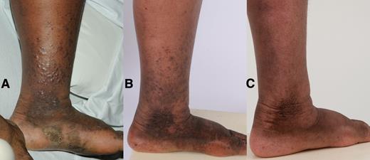 Figure 1. Photograph of representative area of Kaposi sarcoma (KS) in a patient with advanced KS and KSHV-associated multicentric Castleman disease. Photos taken at (A) baseline: >50 lesions on the left lower extremity, many nodular, with tumor-associated edema; (B) after completion of R-Dox: substantial flattening of nodular lesions, decreased tumor-associated edema; and (C) 1 year after completion of additional liposomal doxorubicin: resolution of nodular lesions, some residual pigmentation, and edema.
