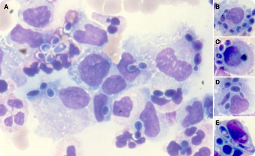 A 42-year-old man was diagnosed with a severe acute respiratory distress syndrome following inhalation of his stomach contents. The previous history revealed liver cirrhosis due to alcoholic liver disease. Seven days later, he presented with a high fever and a painful abdominal distension due to ascites. The blood cell count was as follows: hemoglobin, 10.9 g/dL; white blood cells, 12.230 × 109/L (neutrophils, 9.124 × 109/L); and platelets, 124 × 109/L. The ascitic fluid analysis showed total nucleated cells of 0.242 × 109/L (neutrophils, 29%; lymphocytes, 9%; monocytes, 53%; peritoneal cells, 9%). Microscopic examination showed a mix of isolated, clumped, and budding “pearls” inside or outside the macrophagic cells (panel A). The yeasts had been phagocytized by neutrophils, macrophages, and peritoneal cells and sometimes were arranged as a ring in their cytoplasm (panels B-E). They were identified as Candida albicans, and similar yeasts were identified in the tracheal aspirate. In conjunction with the management of the whole disorder, the patient received fluconazole through an intravenous catheter and recovered after weeks. / Candida sp. infections are well documented in immunocompromised patients. In such a context, the infection is not always accompanied by increased neutrophils in the blood or in the ascitic fluid. Peritoneal cells are capable of phagocytizing microorganisms as neutrophils and monocytes/macrophages do.