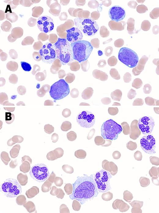 A 69-year-old man presented with anemia (hemoglobin, 77 g/L), thrombocytopenia (platelets, 84 × 109/L), and leukocytosis (white blood cell count, 31 × 109/L) including monocytosis (2.61 × 109/L). Blood film showed a leukoerythroblastic picture with nucleated red cells and blasts. Neutrophils had dysplastic features such as hyposegmented and hypersegmented nuclei, rare circular nuclei, and hypogranulation. Blasts, including myeloblasts, monoblasts, and promonocytes, comprised 8% of leukocytes. Some blasts contained Auer rods (panel A). Marrow aspiration demonstrated a hypercellular marrow with 13% blasts, including monoblasts and promonocytes which have open lacey chromatin and prominent nucleoli like monoblasts but with indented/folded nuclei (Br J Haematol. 2014;165(3):273-286), trilineage dysplasia, and Auer rods (panel B). Flow immunophenotyping showed most blasts were CD34-negative, including myeloid and monocytic subsets. Cytochemistry was not performed. Cytogenetic analysis showed a normal karyotype. These findings were consistent with chronic myelomonocytic leukemia type 2 (CMML-2) as per the World Health Organization 2008 diagnostic criteria. Presence of Auer rods fulfilled criteria for CMML-2, irrespective of the blast count. / Auer rods are a feature of some acute myeloid leukemias, but may be seen in refractory anemia with excess blasts type 2 and rarely in CMML-2 as demonstrated here. Presence of Auer rods indicates aggressive disease with risk of transformation into acute leukemia.