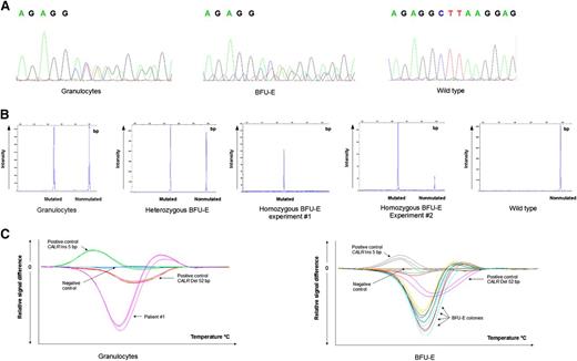 Figure 1. CALR mutations. CALR mutations determined using (A) sequencing, (B) product sizing analysis, and (C) HRM curve analysis in peripheral blood granulocytes and in BFU-E from patient 1. The homozygous BFU-E was tested twice, showing 100% and 83% allele burden. In the later experiment, the WT peak was probably due to contaminating monocytes from the media. WT, wild-type.