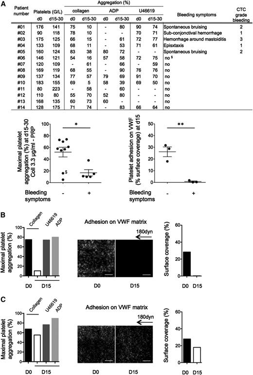 Figure 2. Platelet functions of CLL and MCL patients treated with Imbruvica (ibrutinib). (A) Clinical and biological data were collected before initiation of the treatment (day 0) and after 2 to 4 weeks of treatment (days 15-30). Platelet aggregation induced by collagen (3.3 µg/mL), adenosine 5′-diphosphate (5 µM), or U46619 (5 µM) on PRP was assessed as in Figure 1 at day 0 and days 15 to 30 and expressed as means ± SEM. It is noteworthy that platelet aggregation induced by collagen at day 0 was slightly reduced in the patients group compared with healthy donors (88 ± 6% for healthy donors and 69 ± 7% for patients, P < .01, n = 19 healthy donors). Of note, in the nonbleeding group at days 15 to 30, patients 06 and 10 had a strong reduction of aggregation. Importantly, patient 06 ($) experienced a severe metrorrhagia at day 50. Platelet adhesion on VWF matrix was assessed for 6 patients (01, 02, 03, 07, 08, and 14) as in Figure 1 and expressed as the surface coverage. Results are presented as means ± SEM. (B) Example of a patient (01) showing platelet dysfunction and bleeding symptoms on ibrutinib treatment. (C) Example of a patient (08) with normal platelet responses and no hemostasis-related adverse effect on ibrutinib treatment. Hyperleukocytosis was not correlated to ex vivo platelet dysfunction. *P < .05 and **P < .01. D0, day 0; D15, day 15.