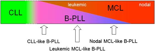 Figure 6. Hypothetical model for the spectrum from CLL, B-PLL, and MCL. CLL is different from MCL and B-PLL. Some B-PLL cases, probably all t(11;14)-negative, have some similarities with CLL and may have a relatively good prognosis (CLL-like B-PLL). Another subgroup of B-PLL is indistinguishable from leukemic MCL patients (leukemic MCL-like B-PLL); this subgroup contains both t(11;14)-positive and t(11;14)-negative patients. A third B-PLL subgroup is comparable to but distinguishable from nodal MCL (nodal MCL-like B-PLL).