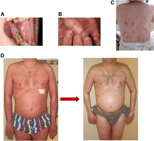 Figure 3. Clinical images of chronic GVHD. (A) Lichen planus-like lesions on buccal mucosa showing a lacework of white streaks and erosions. (B) Lichen planus lesions of the nails showing thinning of the nail plate, longitudinal lines, and pterygium formation. (C) Skin lichen planus lesions with shiny and violaceous papules of the back. (D) Edematous erythroderma with lichenoid features evolving into diffuse sclerodermatous changes of the skin.