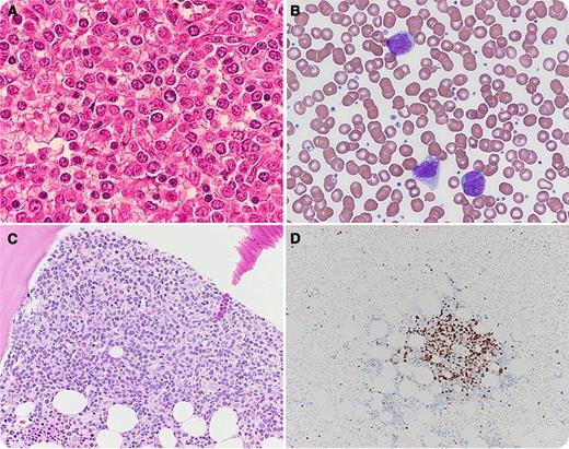 A 56-year-old male presented to the emergency department with acute abdominal pain. Computed tomography scan showed multiple cervical, supraclavicular, periaortic, and mesenteric lymphadenopathy; a ruptured spleen measuring 19 cm; and free intraperitoneal hemorrhage. He underwent an emergent splenectomy and laparotomy. Pathology demonstrated a completely effaced spleen with intermediate- to large-sized lymphocytes with prominent nucleoli admixed with small cleaved lymphocytes (panel A). Neoplastic cells in the spleen were λ light chain restricted and CD5+/CD19+/CD20+ (bright). Fluorescence in situ hybridization results revealed overexpression of CyclinD1 and chromosomal translocation t(11:14)(q13;q32), consistent with mantle cell lymphoma (MCL). Laboratory tests showed white cell count 15.5 × 109/L and 40% lymphocytes. Peripheral smear revealed predominance of large atypical lymphocytes with large nuclei and distinct nucleoli resembling prolymphocytes (panel B). Bone marrow biopsy disclosed paratrabecular and interstitial infiltration of small- to medium-sized abnormal cleaved lymphocytes with large cells with distinct nucleoli (panel C). Immunostaining demonstrated expression of CyclinD1 (panel D) and SOX11, and cytogenetics confirmed chromosomal translocation t(11;14). / Morphology, immunophenotype, and molecular studies are consistent with pleomorphic MCL, previously described as MCL with leukemic variant. Peripheral blood lymphoid cells are similar to prolymphocytes, which may lead to splenic rupture. Thus, it is important to differentiate pleomorphic MCL from prolymphocytic leukemia because the treatments are different.