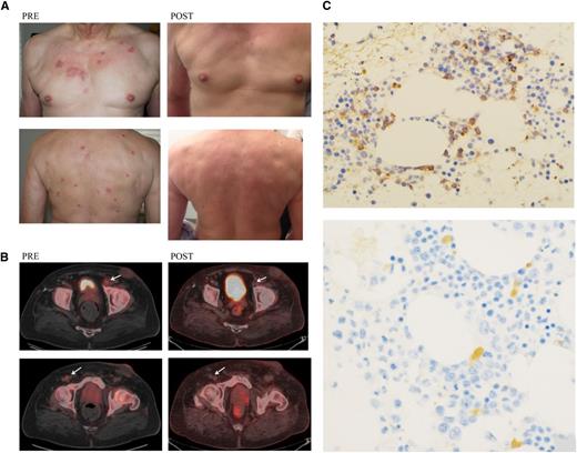 Figure 2. Photographs of skin, PET/CT scan, and bone marrow biopsy, pre– and post–SL-401. (A) Involved skin of patient 7 photographed before treatment and 4 months after treatment. (B) PET/CT images for patient 6 scanned before treatment and 1 month after treatment, demonstrating enlarged and PET-avid left inguinal node (1.2 × 1.6 cm; standardized uptake value Max 3.5) and right inguinal node (0.7 × 1 cm; standardized uptake value 2.3) before treatment. These inguinal nodes regressed and were no longer PET-avid at 1 month after treatment. (C) Immunostaining for CD123 on a bone marrow aspirated from patient 1 before treatment and at 1 month after treatment. Pretreatment showed 10% positive cells and after therapy showed <1% to 2% positive cells. Magnification pretreatment microphotograph is ×20; magnification post-treatment microphotograph is ×40.