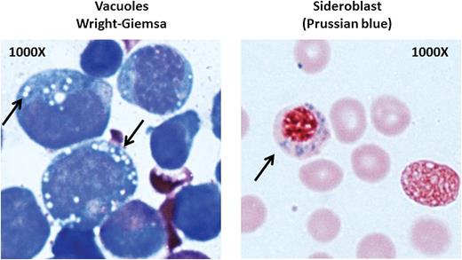 Bone marrow from a patient with PS. Left: vacuoles in myeloid precursors; right: a ringed sideroblast. See Figure 1E in the article by Gagne et al that begins on page 437.