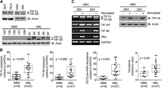 Figure 1. Expression of full-length TIF-IA protein (TIF-FL) and TIF-90 in normal, leukemic, and proliferating hematopoietic cells. (A) Expression of TIF-FL and the TIF-90 variant in cancer cell lines and primary leukemic cells (AML, n = 10) (top) and in representative individual normal bone marrow and leukemic cells (bottom) by western blot. (B) Quantitative expression of (1) TIF-FL mRNA, (2) TIF-90 mRNA, (3) pre-rRNA synthesis, and (4) Pol I occupancy of the rDNA promoter by qPCR in bone marrow mononuclear cells from normal individuals and from patients with AML. The bar indicates the average value, and the ends of the whiskers represent minimum and maximum values. Significance was determined using the Student t test. (C) Expression of TIF-FL and TIF-90 transcripts and protein in normal peripheral blood mononuclear cells from 2 individuals before and 22 hours after stimulation with phorbol ester and ionomycin: RT-PCR (left); western blot (right).