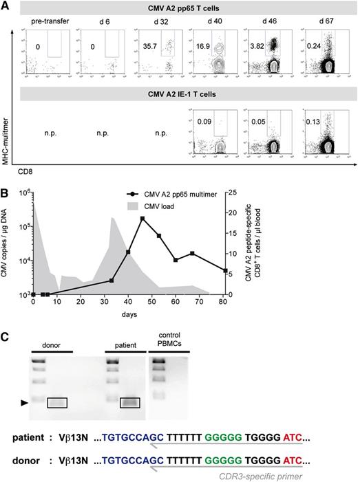 Figure 4. Expansion of CMV-specific CD8+ T cells after low-dose T-cell transfer in a SCID patient. A 10-month-old boy with SCID syndrome and generalized CMV disease (patient 1) had been reconstituted with PBSCs from the father. Fourteen days after allo-HSCT, 30 000 donor-derived CMV HLA-A0201/pp65-peptide–specific CD8+ T cells (3750 per kg body weight) were infused. Patient-derived PBMCs were analyzed at different time points before and after adoptive transfer. (A) Visualization of CMV HLA-A0201/pp65-peptide–specific T cells using MHC multimers. The frequencies among CD3+ T cells are indicated. Additionally, the kinetics of endogenously selected CMV HLA-A0201/IE-1-peptide–specific CD8+ T cells of respective time points are illustrated (n.p., not performed). (B) Comparison of CMV-specific T-cell kinetics and CMV detection. The absolute numbers of CMV HLA-A0201/pp65-peptide–specific T cells (circles) are indicated. CMV load was measured in the peripheral blood via quantitative PCR (filled gray). (C) Tracking of donor-derived CMV HLA-A0201/pp65–specific CD8+ T cells. Amplified donor and patient PCR products of an identified CDR3 region are shown (left). In control PBMCs, no product amplification was detectable. Detected PCR products (∼193 bp) were subsequently sequenced. The isolated sequences of the CDR3 region from patient and donor are shown in detail (right; blue: V segment; green: D segment; red: J segment).