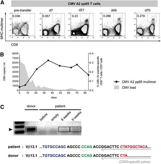 Figure 5. Proliferation of CMV-specific CD8+ T cells in a patient with haploidentical HSCT after B-ALL. A 14-year-old boy with B-ALL (patient 2) and therapy-refractory CMV reactivation after haploidentical allo-HSCT was treated with Streptamer-purified CMV-specific CD8+ T cells. He received 5130 cells per kg (in total 200 000 cells) stem cell donor–derived CMV HLA-A0201/pp65-peptide–specific T cells 5 months after allo-HSCT. Patient-derived PBMCs were analyzed at different time points before and after adoptive transfer. (A) CMV HLA-A0201/pp65-peptide–specific T cells were visualized with MHC multimers, and selected time points are demonstrated. The frequencies among CD3+ T cells are indicated. (B) Comparison of CMV-specific T-cell kinetics and CMV detection. The frequency of CMV HLA-A0201/pp65-peptide–specific cells among CD3+ T cells is indicated (circles). CMV load was measured in the peripheral blood via quantitative PCR (filled gray). (C) Tracking of donor-derived CMV HLA-A0201/pp65–specific CD8+ T cells via CDR3 sequencing. Amplified donor and patient PCR products (8 and 9 weeks) of an identified CDR3 region are shown (top). Detected PCR products were subsequently sequenced. The isolated sequences of the CDR3 region from patient and donor are shown in detail (bottom; blue: V segment; green: D segment; red: J segment).