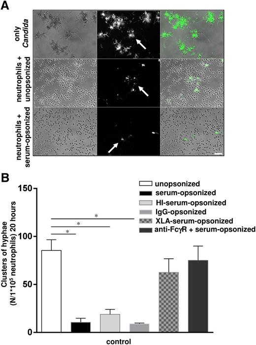 Figure 1. The killing of unopsonized and opsonized C albicans by neutrophils. (A) Neutrophils from healthy controls were cocultured overnight with unopsonized and serum-opsonized C albicans. White arrows indicate the observed clusters of GFP-positive C albicans hyphae. Scale bar is 50 μm. (B) Neutrophils from healthy controls were cocultured overnight with unopsonized, serum-opsonized, HI-serum-opsonized, XLA-serum-opsonized, IgG-opsonized C albicans–GFP or after blocking the FcγRs with mAbs (10 μg/mL) and the clusters of hyphae were assessed microscopically. Results are means ± SEM of at least 3 independent experiments. *P < .05. HI, heat inactivated.