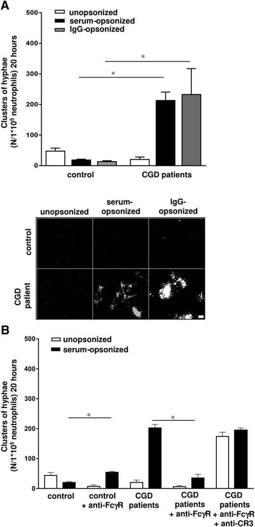 Figure 4. CGD neutrophils fail to kill serum-opsonized C albicans. (A) Neutrophils from healthy controls and CGD patients E to L were cocultured overnight with C albicans–GFP, and the clusters of hyphae were assessed microscopically. Scale bar is 50 μm. (B) The inhibition of serum-opsonized C albicans germination by untreated, anti-FcγR (10 μg/mL) or anti-CR3/FcγR (10 μg/mL) treated neutrophils from healthy controls and CGD patients. Results are means ± SEM of at least 3 independent experiments. *P < .05.
