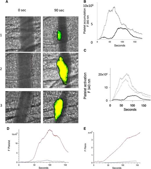 Figure 2. Enhanced platelet activation at the site of vascular injury with infusion of anti-β2GP1 autoantibodies. Mice were infused with platelets loaded with fura-2-AM (250 × 106/mouse). Monitoring fluorescence at 380 nm allowed quantitation of platelet accumulation (unliganded fura-2, green) and monitoring fluorescence at 340 nm allowed quantitation of activated platelets (Ca+2 liganded fura-2, red; yellow = merge). (A) Images of the developing thrombus at time 0 and at 90 seconds obtained without (panel 1), with infusion of 10 μg anti-β2GP1 IgG (panel 2) and with infusion of 12 μg anti-β2GP1 F(ab′)2 (panel 3). Resting platelets, green; activated platelets, yellow. (B) Platelet accumulation after laser-induced injury is represented by the median fluorescence intensity of loaded platelets excited at 380 nm over 3 minutes in 20 thrombi in 4 mice before (black) and in 25 thrombi after (gray) infusion of 10 μg of anti-β2GP1 IgG. (C) Platelet activation at the site of laser-induced injury is represented by the median fluorescence intensity of fura-2-AM–loaded platelets excited at 340 nm over 3 minutes in 20 thrombi in 4 mice before (black) and 25 thrombi after (gray) infusion of 10 μg of anti-β2GP1 IgG. (D) F(ab′)2 of anti-β2GP1 IgG-induced enhancement of platelet accumulation. (E) F(ab′)2 of anti-β2GP1 IgG-induced enhancement of fibrin generation. Platelet accumulation and fibrin generation at the site of laser-induced injury were measured before and 20 minutes after infusion of 12 μg of F(ab′)2 of anti-β2GP1 IgG. Platelet and fibrin labeling were performed using anti-CD42 antibody labeled with Dylight 488 (0.1 μg/g) and anti-fibrin antibody labeled with Alexa 647 (0.5 μg/g). F(ab′)2 of anti-β2GP1 IgG-induced changes in platelet thrombus size and fibrin generation were observed in thrombi performed upstream in a single arteriole before (blue, 16 thrombi, 3 mice) and 20 minutes after infusion of 12 μg of F(ab′)2 of anti-β2GP1 IgG (red, 12 thrombi, 2 mice).