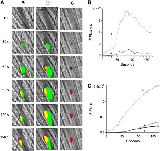Figure 6. Inhibition of platelet thrombus formation with eptifibatide prevents anti-β2GP1 autoantibody–mediated enhancement of fibrin generation. Platelet and fibrin imaging were performed using anti-CD42 antibody labeled with Dylight 488 (0.1 μg/g mouse) and anti-fibrin antibody labeled with Alexa 647 (0.5 μg/g mouse). Platelet thrombus size and fibrin generation at the site of laser-induced injury were determined by calculating median fluorescence values at 488 nm and 647 nm over 3 minutes, respectively. Anti-β2GP1 autoantibody–induced changes in platelet thrombus size and fibrin generation were observed in thrombi performed upstream in a single arteriole before (16 thrombi, 3 mice) and 15 minutes after (20 thrombi, 3 mice) infusion of 10 μg of anti-β2GP1 antibodies. Subsequently, platelet accumulation at the site of injury was prevented by infusion of eptifibatide (10 μg/g mouse) every 15 minutes, and platelet thrombus size and fibrin generation were observed in thrombi (19 thrombi, 3 mice) performed upstream in a single arteriole in the presence of anti-β2GP1 autoantibodies. (A) Representative images of the developing thrombus obtained (a) without antibody, (b) with 10 μg anti-β2GP1 IgG, and (c) with 10 μg anti-β2GP1 IgG and eptifibatide. Platelets, green; fibrin, red; merge, yellow. (B) Platelet accumulation. (C) Fibrin generation. No antibody (a), black; anti-β2GP1 autoantibody (b), light gray; anti-β2GP1 autoantibody and eptifibatide (c), dark gray.