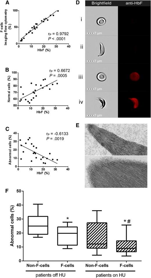 Figure 1. Imaging flow cytometry documents incomplete resistance of human sickle F-cells to ex vivo hypoxia-induced sickling. (A) HbF in the hemolysate correlates positively with the percentage of F-cells detected by SIFCA. HbF protective effect against sickling is shown by a positive correlation with the percent of cells that remain in normal shape after deoxygenation (B), and an opposite correlation with the percent of cells that become sickled (C). Sample images acquired by the imaging flow cytometer show simultaneous brightfield images (left column) and fluorescence of an anti-HbF-PE antibody (right column) in a normal non-F-cell (Di), sickled non-F-cell (Dii), normal F-cell (Diii), and a sickled F-cell (Div). (E) Transmission electron microscopy of RBCs enriched by fluorescence-activated cell sorting was performed to confirm that sickled cells contained similar fibers corresponding to hemoglobin S polymers regardless of whether they were non-F-cells (top) or F-cells (bottom). Bar = 100 nm. Images acquired with a JEM1400 electron microscope (JEOL) equipped with an AMT XR-111 digital camera (Advanced Microscopy Techniques Corporation). Image Adjust-Levels and Image Adjust Brightness functions in Photoshop Creative Suite 6 software (Adobe Systems Corporation) were used to equalize the densities in both images. (F) Non-F-cells sickled more than F-cells in both patients off hydroxyurea (left side, *P = .0014, paired Student t test) and on HU (right side, *P = .0057, paired Student t test), but cells from treated patients sickle less than from untreated patients (Mann-Whitney test, #P = .0197 for F-cells from patients off HU compared with on HU, P = .0501 for comparison between non-F-cells).