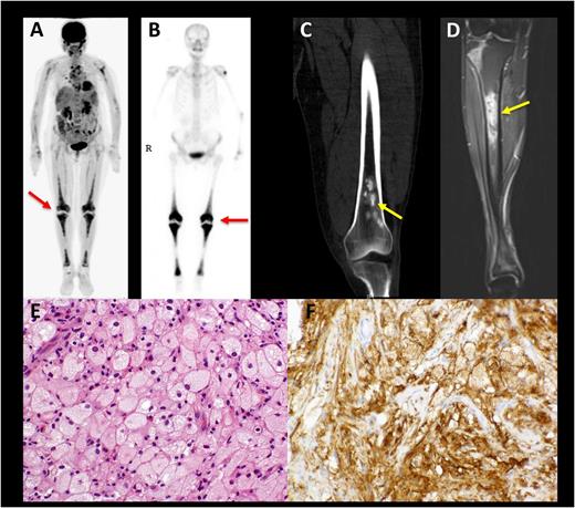 Figure 1. Characteristic histopathologic and radiographic findings of ECD. (A) PET and (B) 99mTc imaging demonstrating symmetric diametaphyseal radiotracer uptake in the long bones of the legs (arrows) commonly seen in ECD patients. R indicates the patient's right side. (C) CT and (D) MRI scans revealing sclerotic lesions of the metaphyses of femur and tibia (arrows). (E) Hematoxylin-eosin–stained biopsy section of ECD lesion revealing lipid-laden histiocytes characteristic of ECD. (F) IHC stain for CD68 revealing positivity of histiocytes.