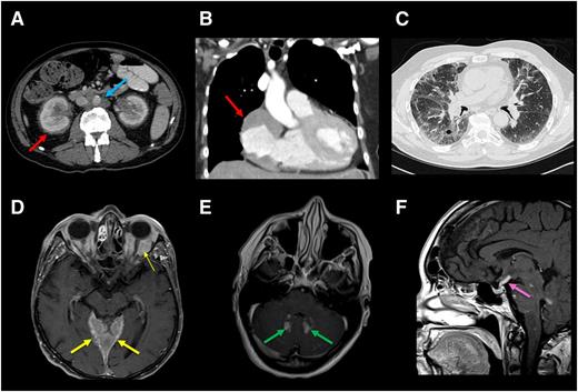 Figure 2. Radiographic findings of internal organ systems commonly affected by ECD. (A) Axial CT scan of abdomen of an ECD patient demonstrating dense infiltration of perinephric fat commonly seen in ECD and referred to as a “hairy kidney” appearance (red arrow). Circumferential soft-tissue sheathing of the thoracic aorta seen in a subset of ECD patients and referred to as a “coated aorta” (blue arrow). Right atrial mass is demonstrated in B. (C) Lung parenchymal infiltration on chest CT in an ECD patient. Axial postgadolinium T1 MRI in (D) demonstrates expansile enhancement of the pachymeninges (thick arrow) as well as orbital masses (thin arrow) and (E) enhancing lesions in the dentate nuclei of the cerebellum. (F) Sagittal postgadolinium T1 MRI shows thickening and enhancement of the pituitary stalk.