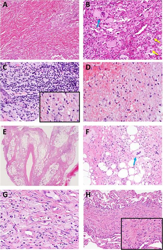 Figure 4. Heterogeneous histopathologic findings in ECD lesional tissue. Brain biopsy in ECD yielded mostly lamellar fibrotic tissue (A) with only small regions (B) with lipid-laden histiocytes (yellow arrows) and Touton giant cells (blue arrow). (C) Another sample of a CNS lesion demonstrated a florid lymphohistiocytic infiltrate with regions of pale, nonfoamy histiocytes (inset). (D) Reactive astrocytes and Rosenthal fibers were seen in a separate CNS biopsy from the same case. (E) Biopsy of perinephric infiltrate on low power view demonstrates perirenal fat with septa widened by fibrous tissue and scant inflammatory infiltrate. The stranding apparent at low power correlates with the known radiographic appearance. (F) Higher power in this case shows a Touton giant cell but few histiocytes. (G) Pericardial biopsy shows pale and granular histiocytes without foamy appearance. Occasional lymphocytes, plasma cells, and eosinophils are present. (H) Lung biopsy from the same patient taken concurrently demonstrates septal fibrosis with scant cellular infiltrate including histiocytes. Higher power (inset) shows pale (nonfoamy) histiocytes.